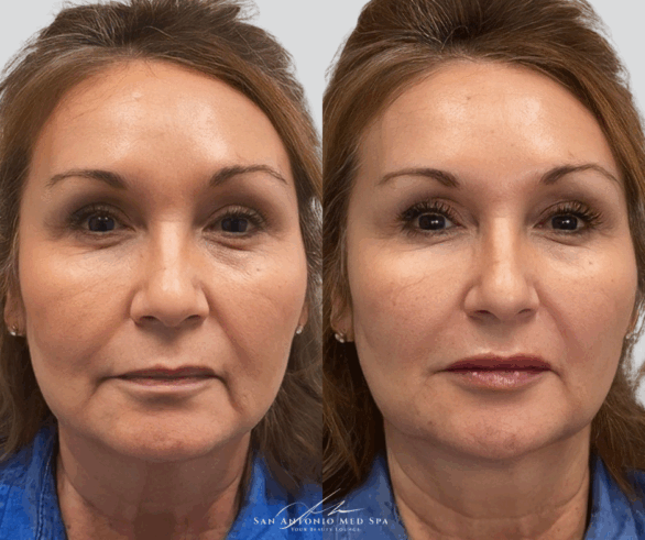 before-after-a-san-antonio-med-spa-in-san-antonio