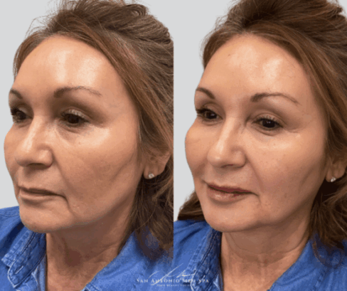 before-after-a-san-antonio-med-spa-in-san-antonio