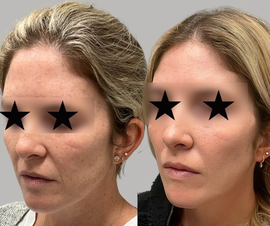 skincare-brown-spots-hyper-pigmentation-san-antonio-med-spa