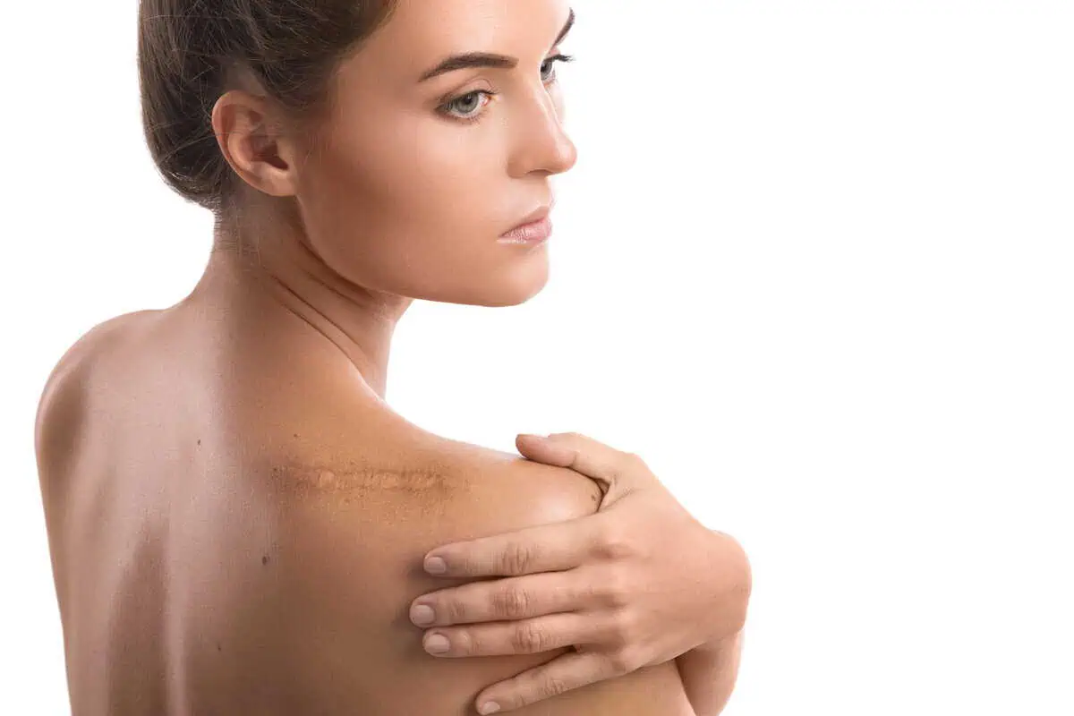 Scar Treatment by San Antonio Med Spa in San Antonio Texas