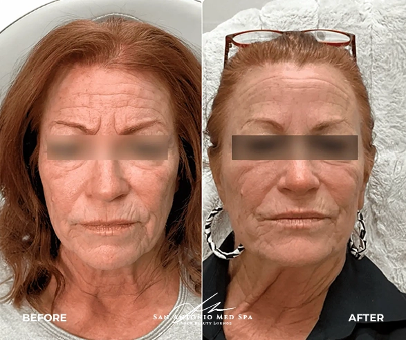 Botox before & after