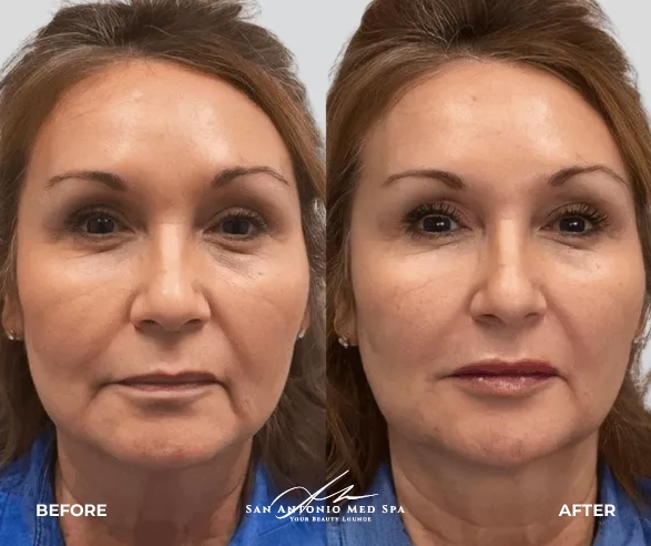 San Antonio Med Spa before & after