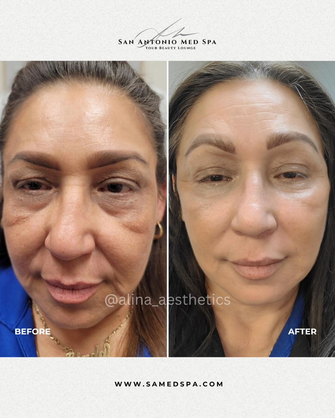 Botox & Fillers