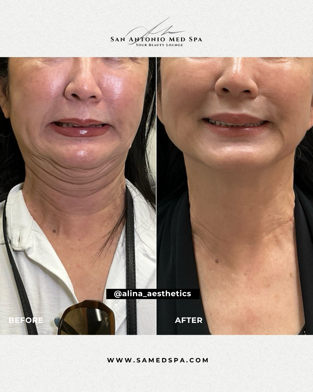 Botox on Neck - Alina White