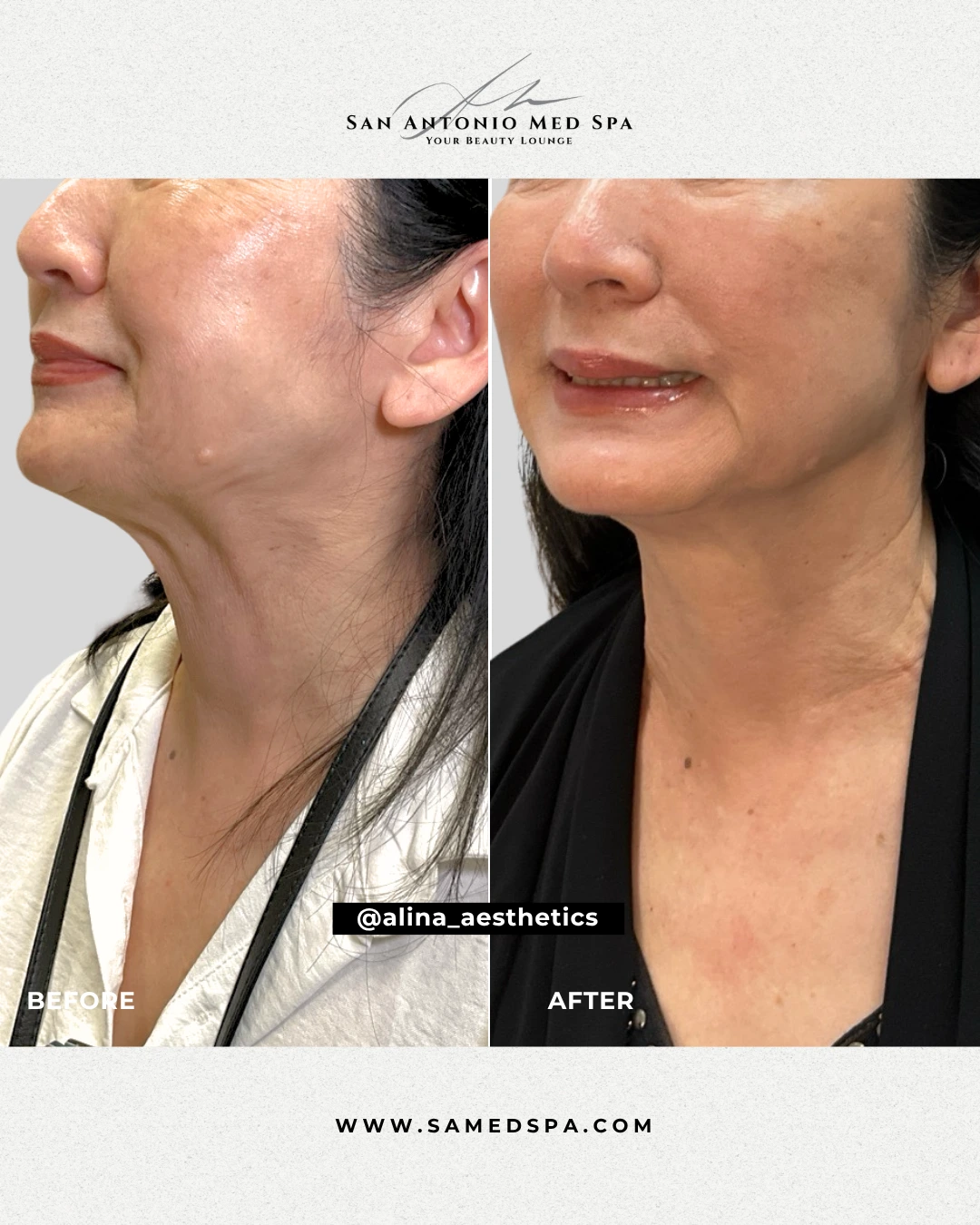 Botox on Neck - Alina White (2)