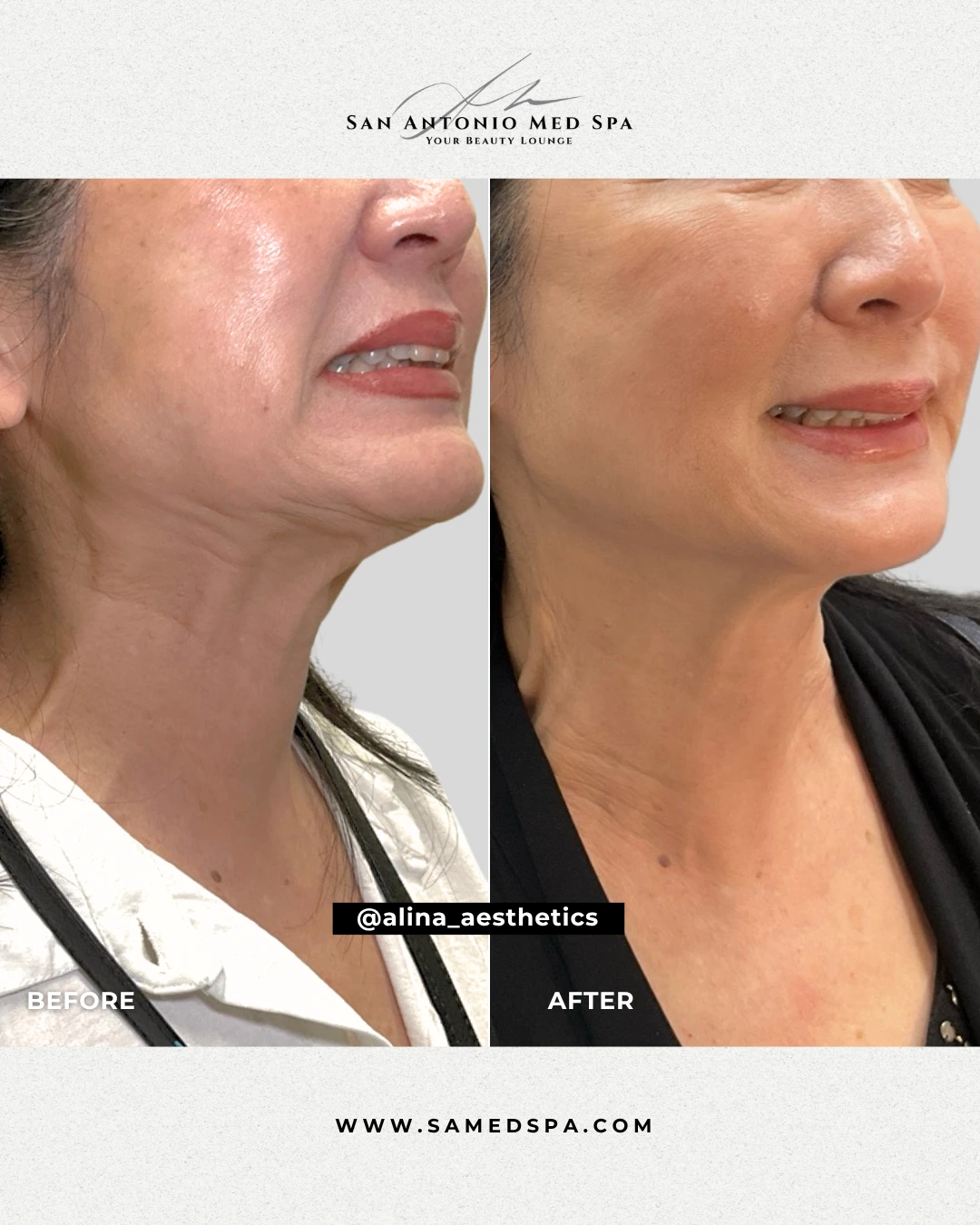 Botox on Neck - Alina White (3)